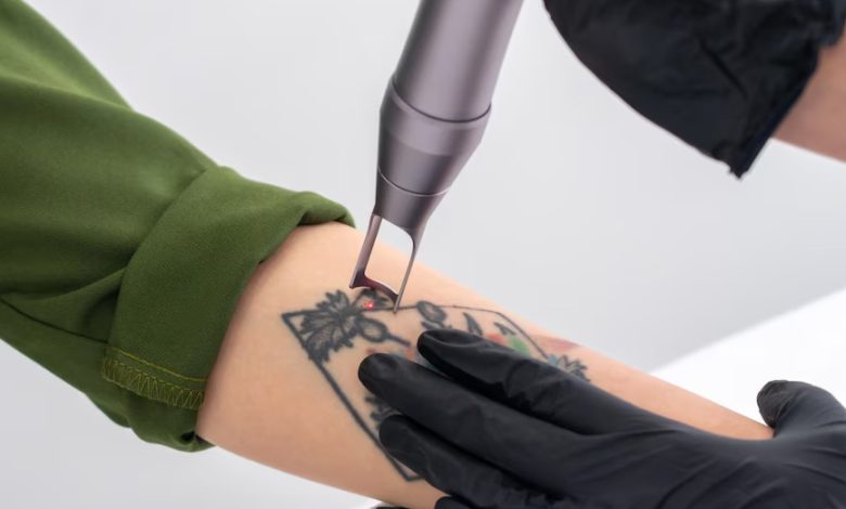 Tattoo Removal in Dhaka